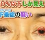 頭痛,肩こり,不眠の原因はまぶたのたるみ？眼瞼下垂症の症状＆見分け方/チェック法＆手術【世界一受けたい授業７月１４日】