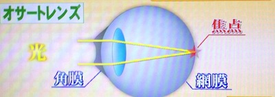 金スマ 視力回復コンタクトレンズ オサート の効果 費用 3月22日