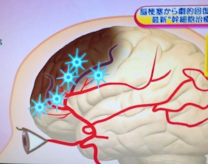 脳梗塞から劇的回復?最新幹細胞治療【NHKあさイチ 3月4日】