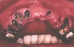 虫歯の画像