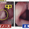 駆け込みドクター ドライノーズの原因と対策&鼻うがいの生理食塩水の作り方/分量【2月1日】