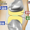 半月板の画像