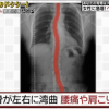 ヘビ背患者のレントゲン写真