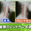 ストレートネック患者のレントゲン写真