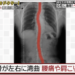 ヘビ背患者のレントゲン写真